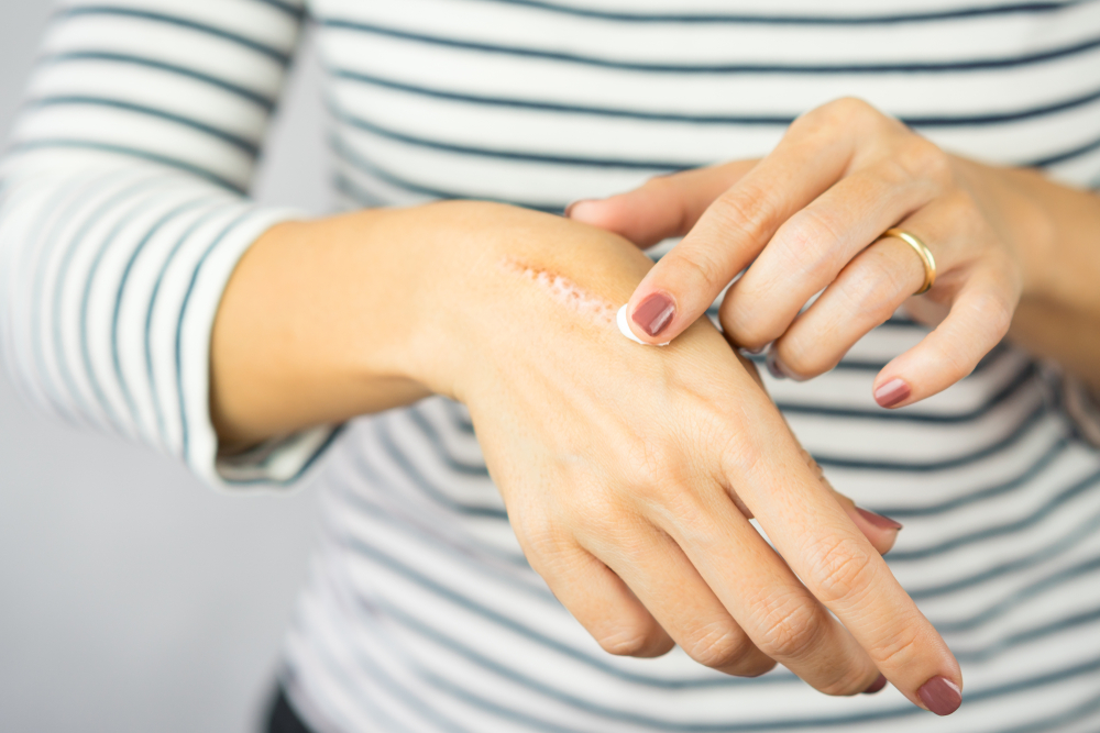 Scar Treatments